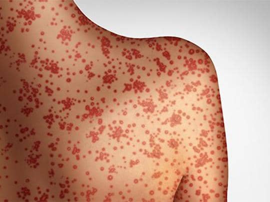 measles-blog-may1-540.jpeg